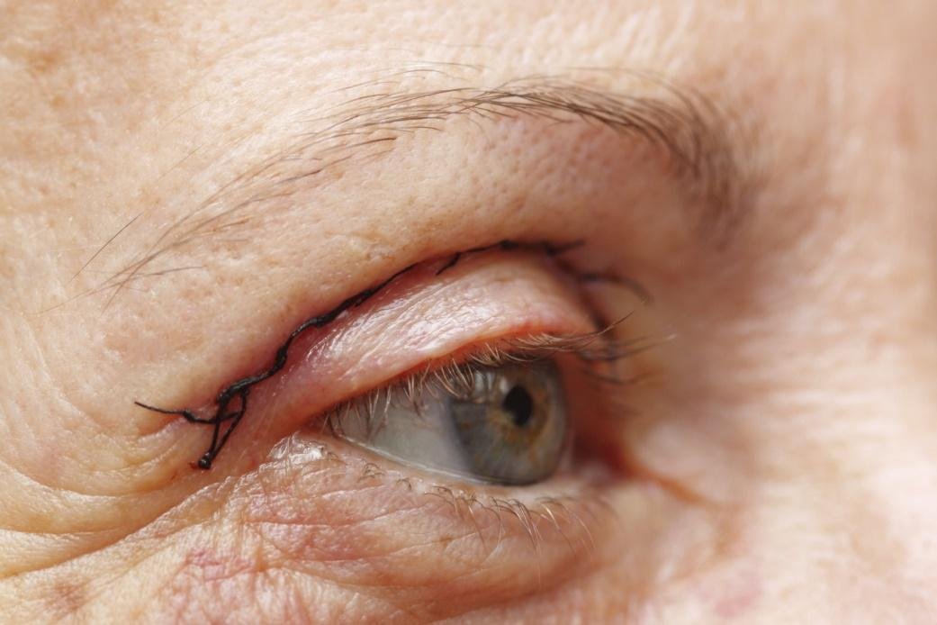 Blépharoplastie