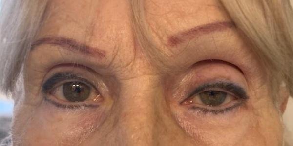PTOSIS article 1